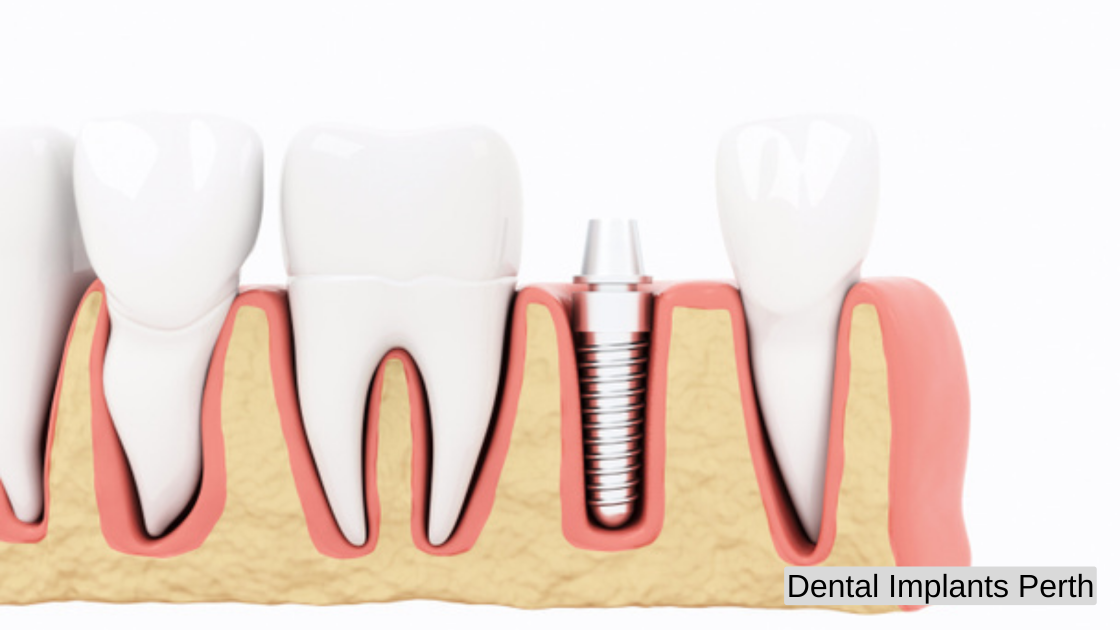 Dental Implants Perth 